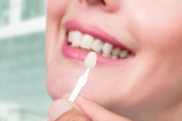 Questions To Ask Your Dentist Before Getting Dental Veneers