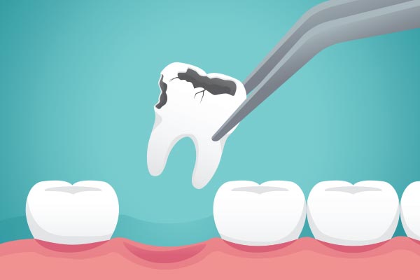 Ask a General Dentist: What Happens to Your Tooth After Extraction from Alexandria Old Town Dental in Alexandria, VA