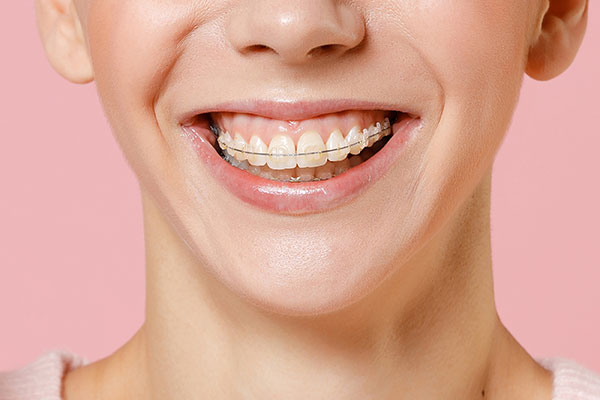 FAQs About Clear Braces Treatment