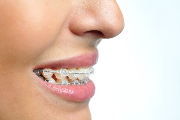 3 Benefits of Clear Braces Alexandria Old Town Dental Alexandria