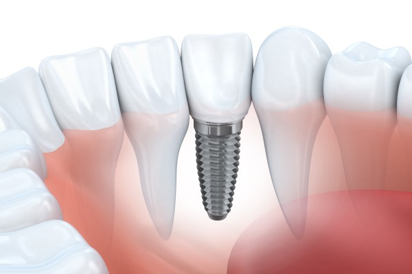When A Dental Implant Restoration May Be Recommended