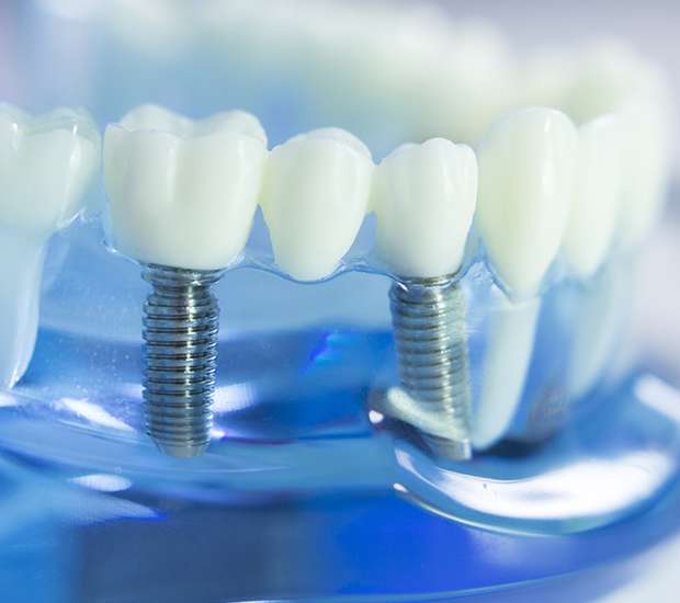 Alexandria Dental Implants
