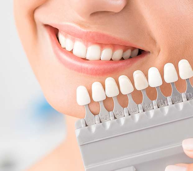 Alexandria Dental Veneers and Dental Laminates