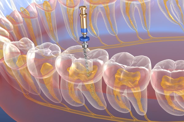 Endodontic Therapy From A General Dentist For A Cracked Tooth