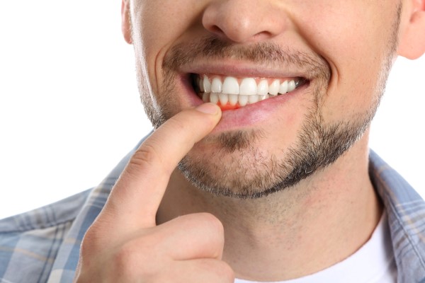 Are There Different Stages Of Gum Disease?