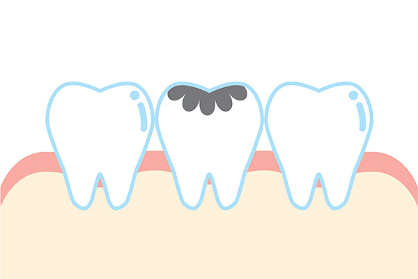 Dental Practice FAQs: How Are Cavities Treated? from Alexandria Old Town Dental in Alexandria, VA