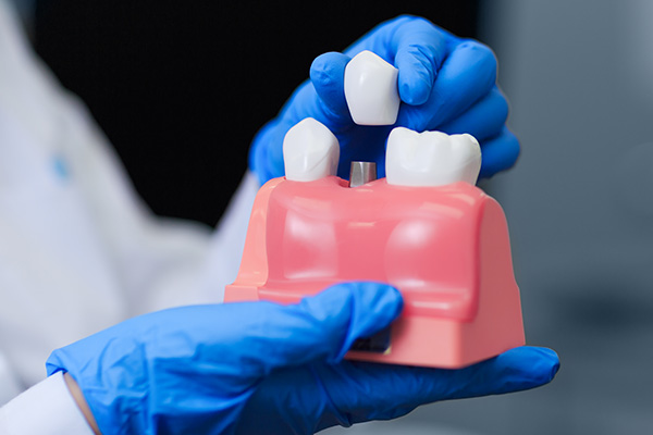 Dental Implant Options For Replacing Missing Teeth