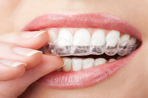 Invisalign Clear Braces Alexandria - Invisible Braces