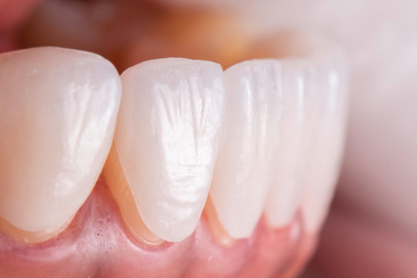 Key Differences Between Dental Veneers And Dental Crowns