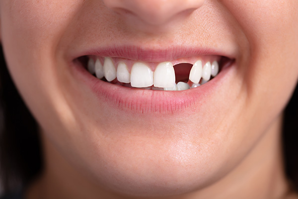 Options for Replacing Missing Teeth: What Procedures Are Recommended for Missing Front Teeth? from Alexandria Old Town Dental in Alexandria, VA