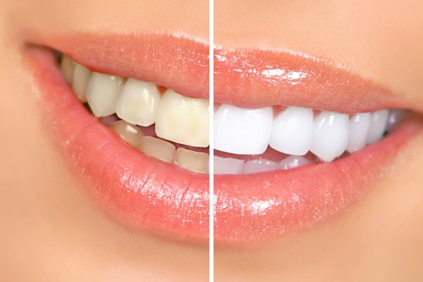 How A Professional Teeth Whitening Can Treat Stained Teeth